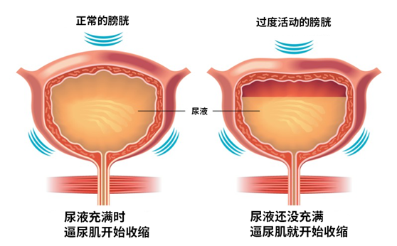 膀胱過(guò)度活動(dòng)癥(OAB)示意圖