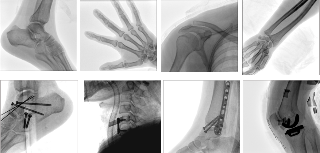 移動式平板C形臂X射線機臨床影像